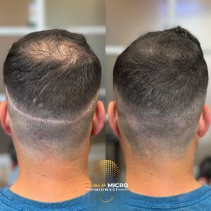 Scar SMP Procedure
